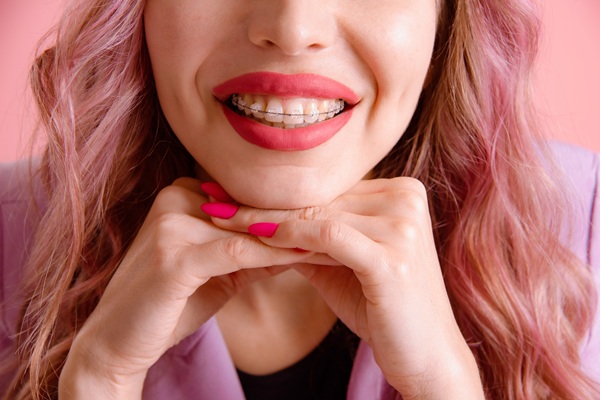 Clear Braces Vs  Aligners