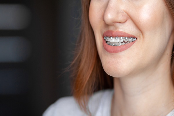 Dental Braces: Types And Applications